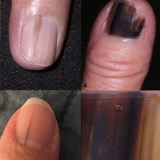 Four small images of nails with dark brown streaks on them