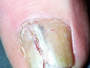 Thick and yellowing nail with melanoma