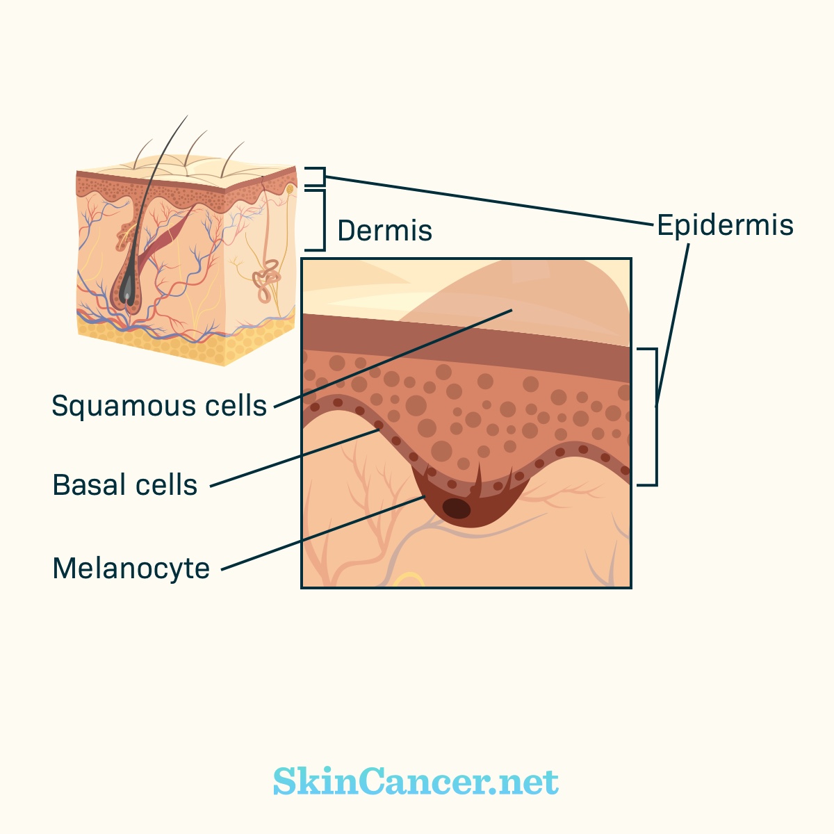 Squamous cell, basal cell, and melanocyte from dermis to epidermis respectively