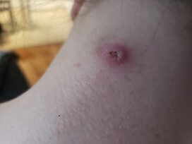 Reoccurring sore on neck not picked at 