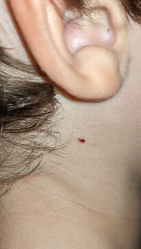 mole on the neck, about 2.5mm