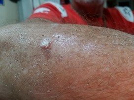 original ingury was a one inch scrape and has healed looking like this.