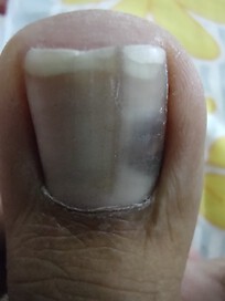 Black mark inside Big toe nail on my right foot.