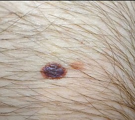 Is this a melanoma 