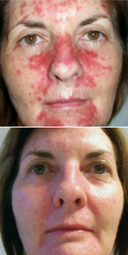 Nolene during-then two weeks after Efudex treatment