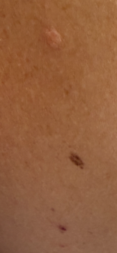 Above mole blister and below mole red mark that keeps leaking and not healing