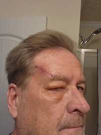 Melanoma removal 