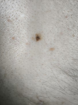 Suspicious lesion 