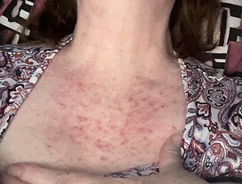 My itchy chest 