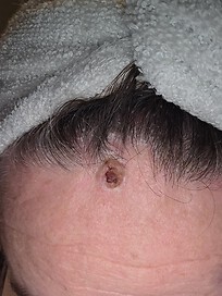 Lesion on my forehead 