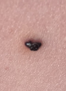 3wks after appearing as a small red blood blister type spot