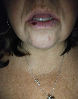 Lip before surgery