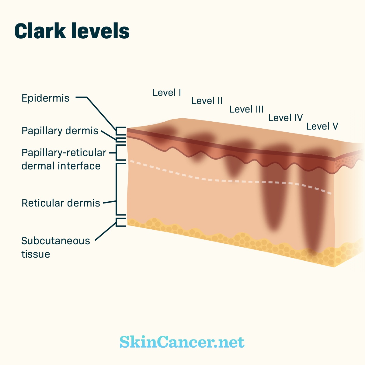 Stages Of Skin Cancer