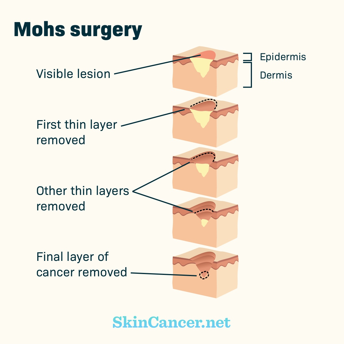 The skin layers and how deep a Mohs surgery must go to remove cancer from the skin