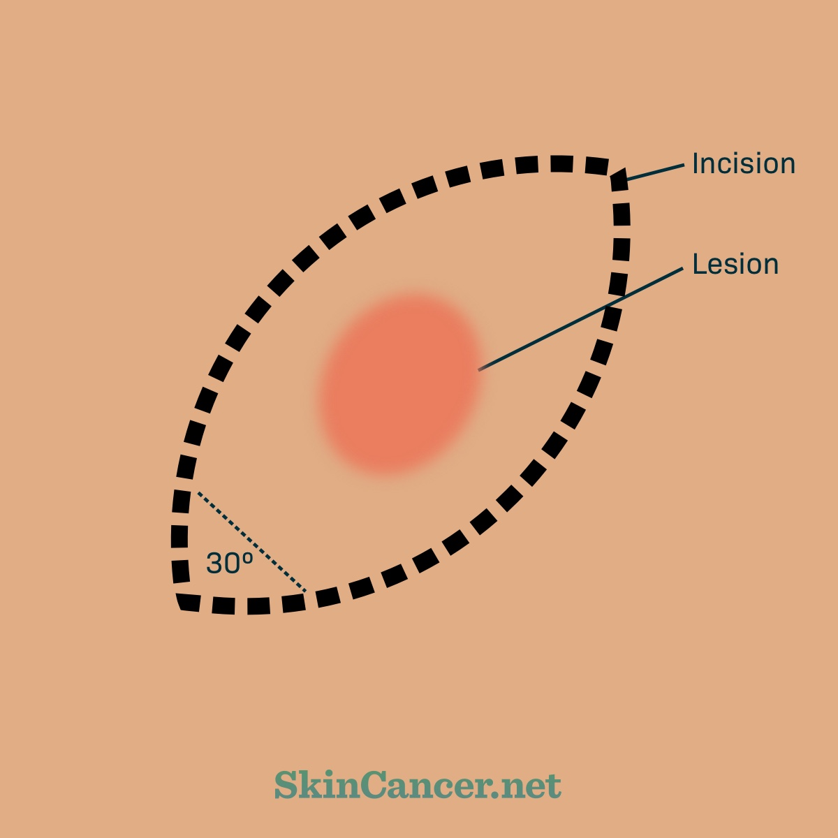 An almond shaped dotted line, the incision, surrounds a red circle, the lesion