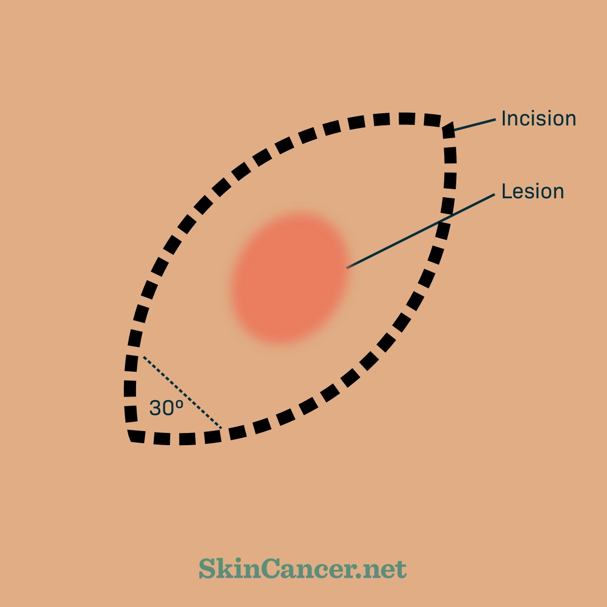 what-you-should-know-about-excision-surgery-for-skin-cancer