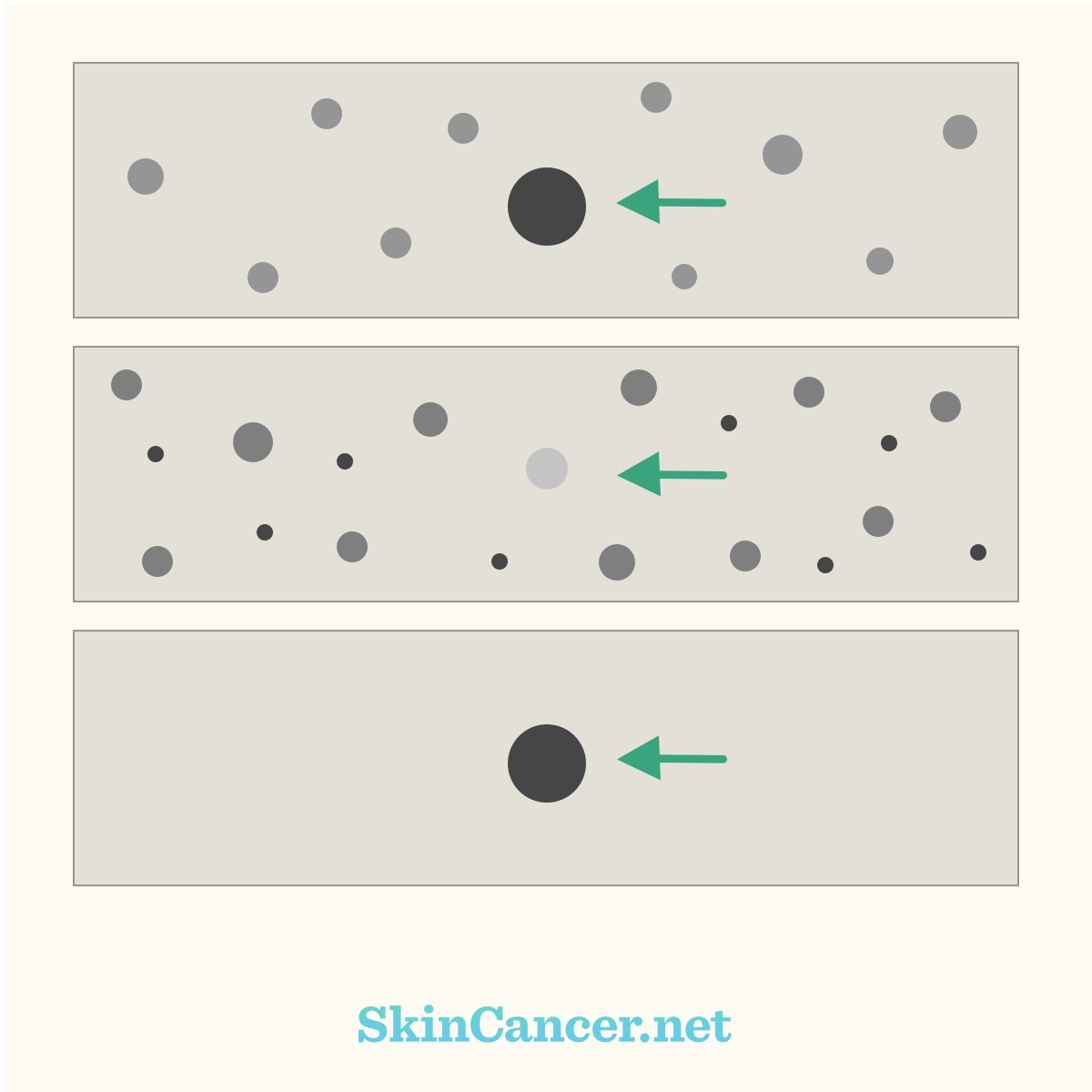 One dot of larger size than others indicates an ugly duckling mole.