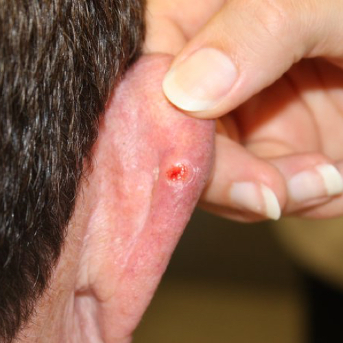 Basal Cell Carcinoma