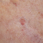 Spotting Skin Cancer: Skin Cancer Images Organized by Type | SkinCancer.net