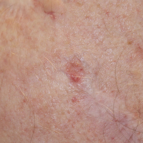 Basal Cell Carcinoma Locations Symptoms And Pictures