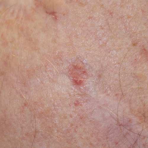 basal cell carcinoma early stages chest