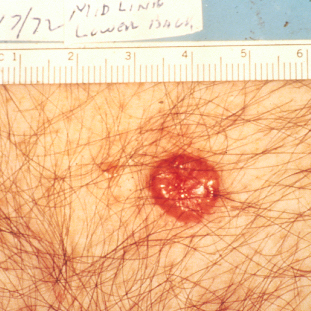 Basal cell carcinoma