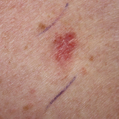 Top 95 Images Pictures Of Basal Cell Carcinoma Sharp 4795