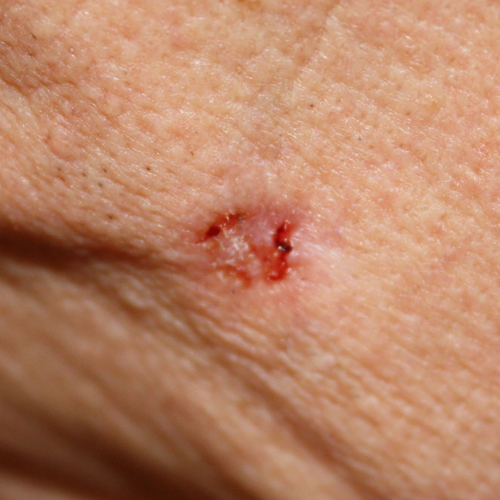 Ulcerated Basal Cell Carcinoma