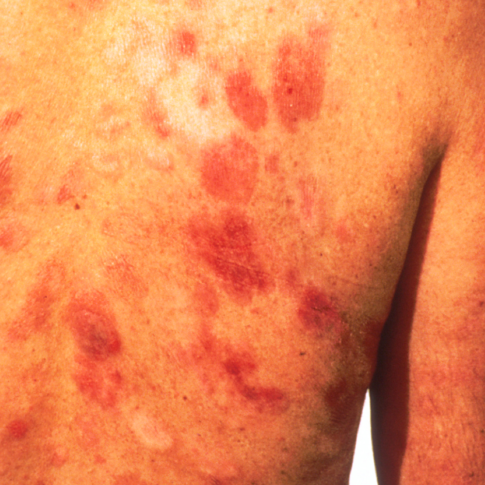 Kaposi's sarcoma after Interferon treatment