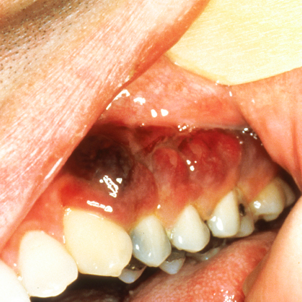 Kaposi's sarcoma in mouth