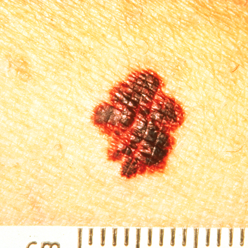 A melanoma with red and brown color and rounded, irregular edges.