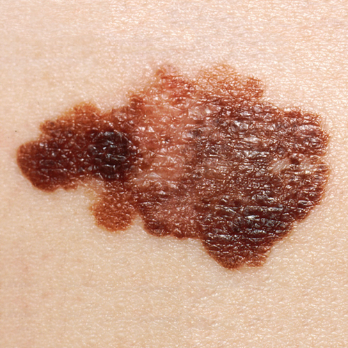 Melanoma with uneven sized splotches of dark brown, light tan, and medium brown.