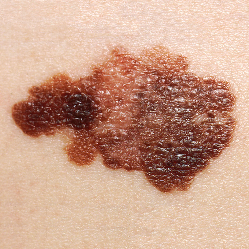 Melanoma