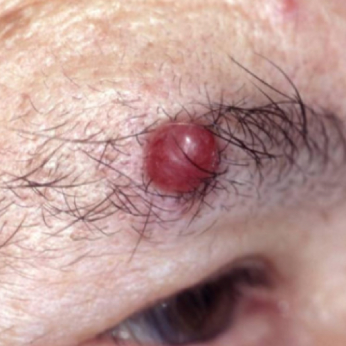 A large red merkel cell carcinoma on a person's eyelid.