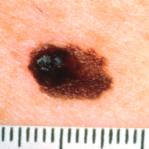 A raised, circular, dark mole with flat, dark cells extending to one side.