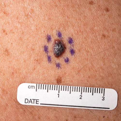 A mole with dermatologist markings around it, with a raised light portion.