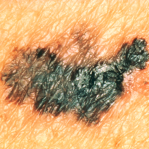 A long, flat melanoma with irregular borders and colors from black to pink.