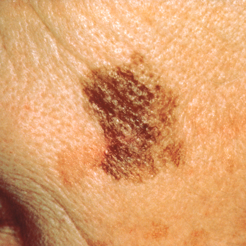 A melanoma with spreading, irregular borders.