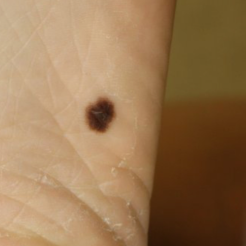 A dark melanoma with irregular borders and lighter color at the edges.