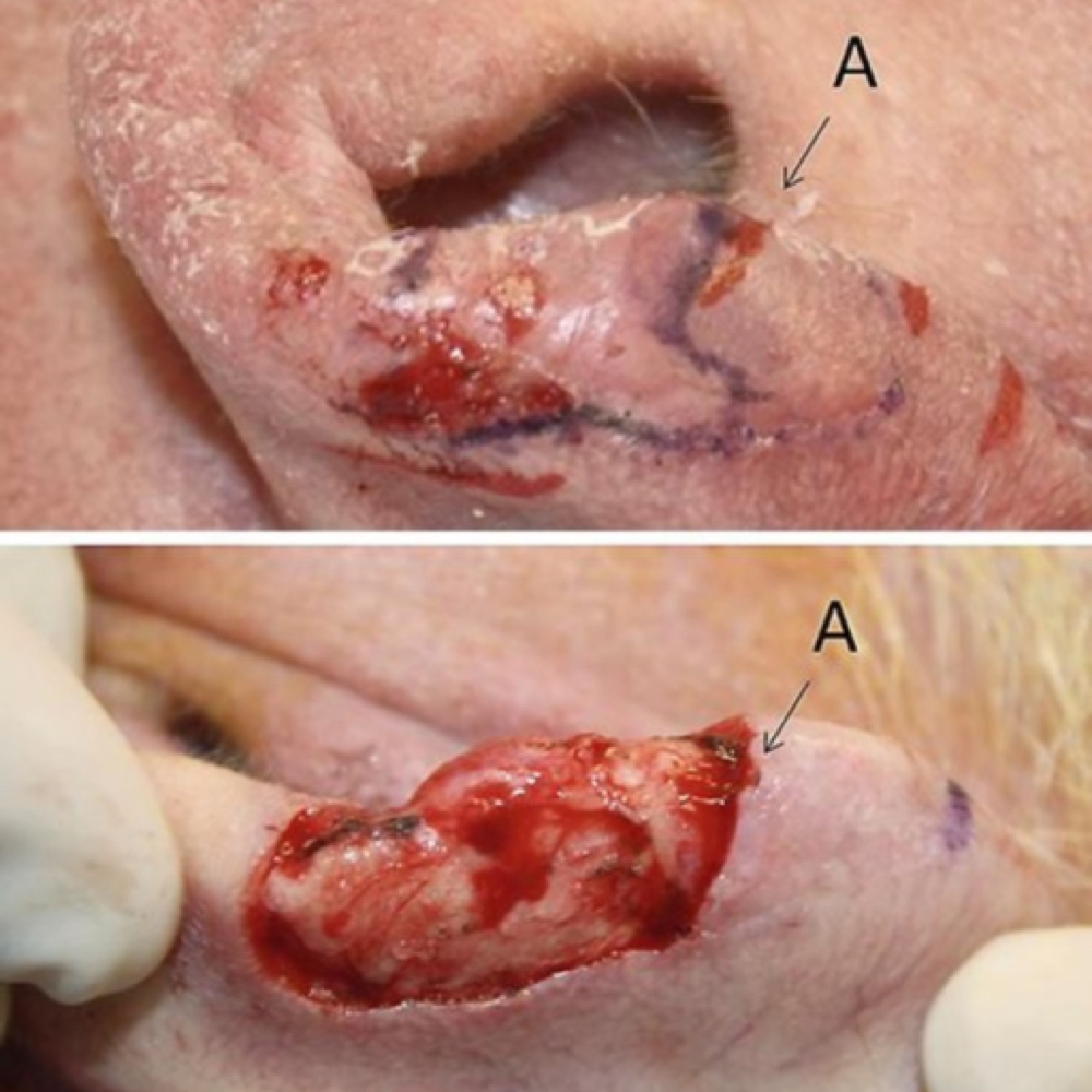 Mohs surgery