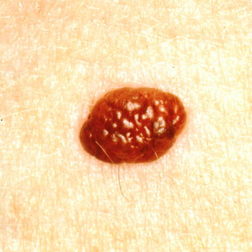 Raised brown mole with some darker coloration, defined edges.