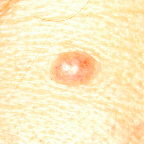 Pearlescent raised mole with blood vessels visible.