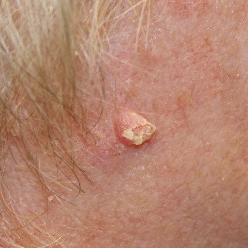 Squamous cell carcinoma that looks like a white skin tag