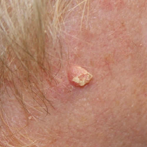 Squamous cell carcinoma