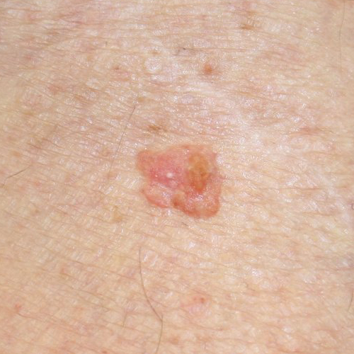 Squamous cell carcinoma on leg that looks like red raised patch of skin