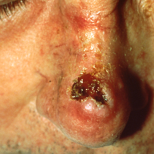 Squamous cell carcinoma on nose