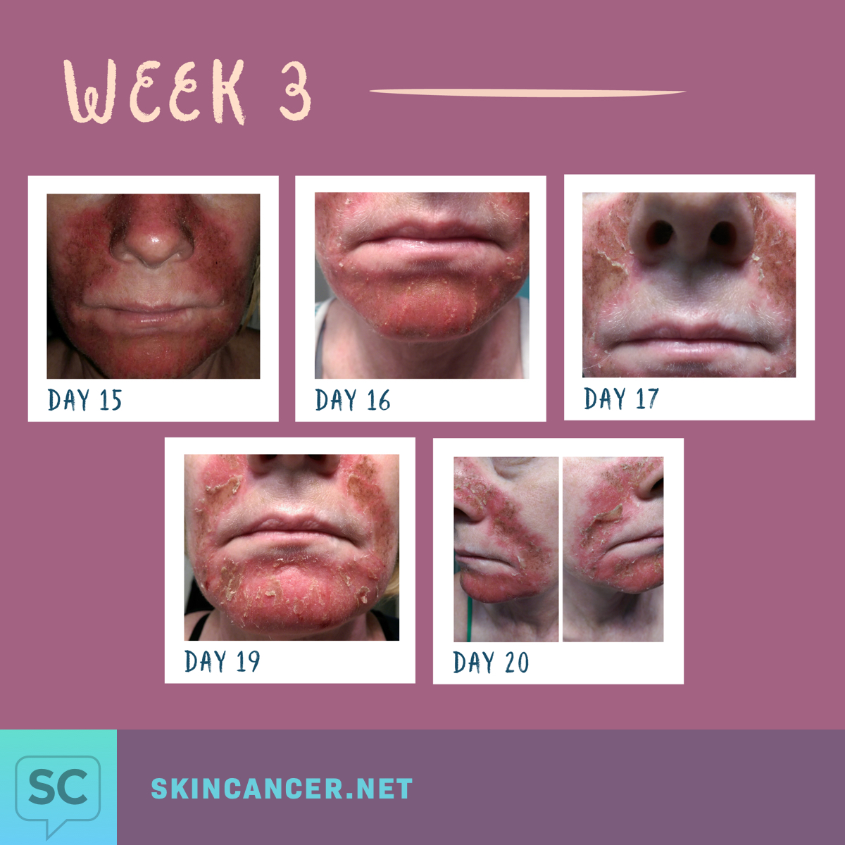 My Journey with Efudex in Photos SkinCancer net