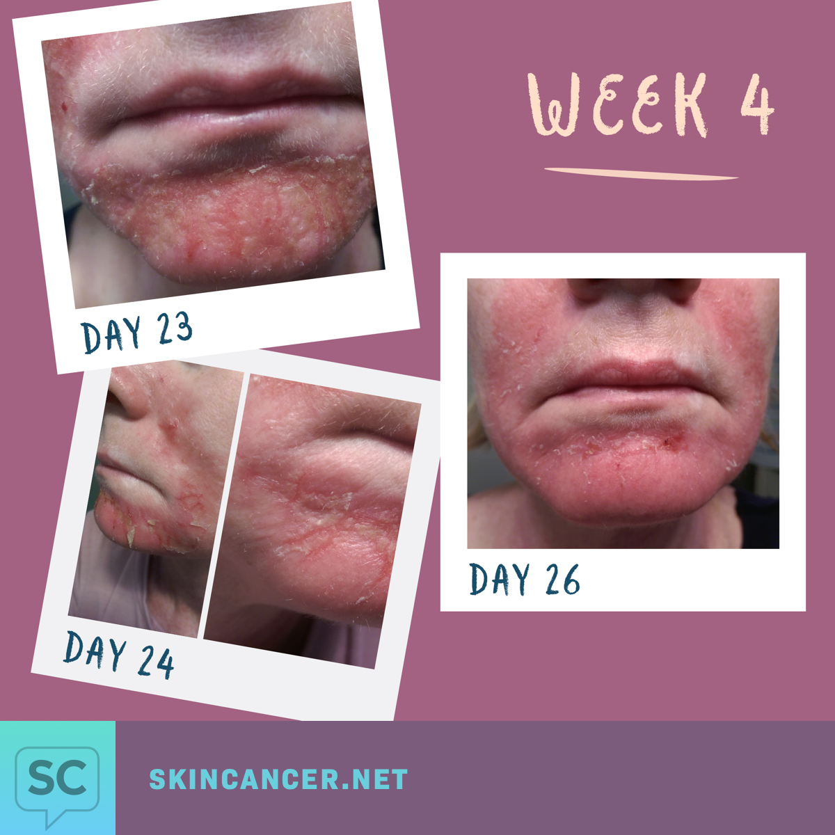 My Journey with Efudex in Photos SkinCancer net