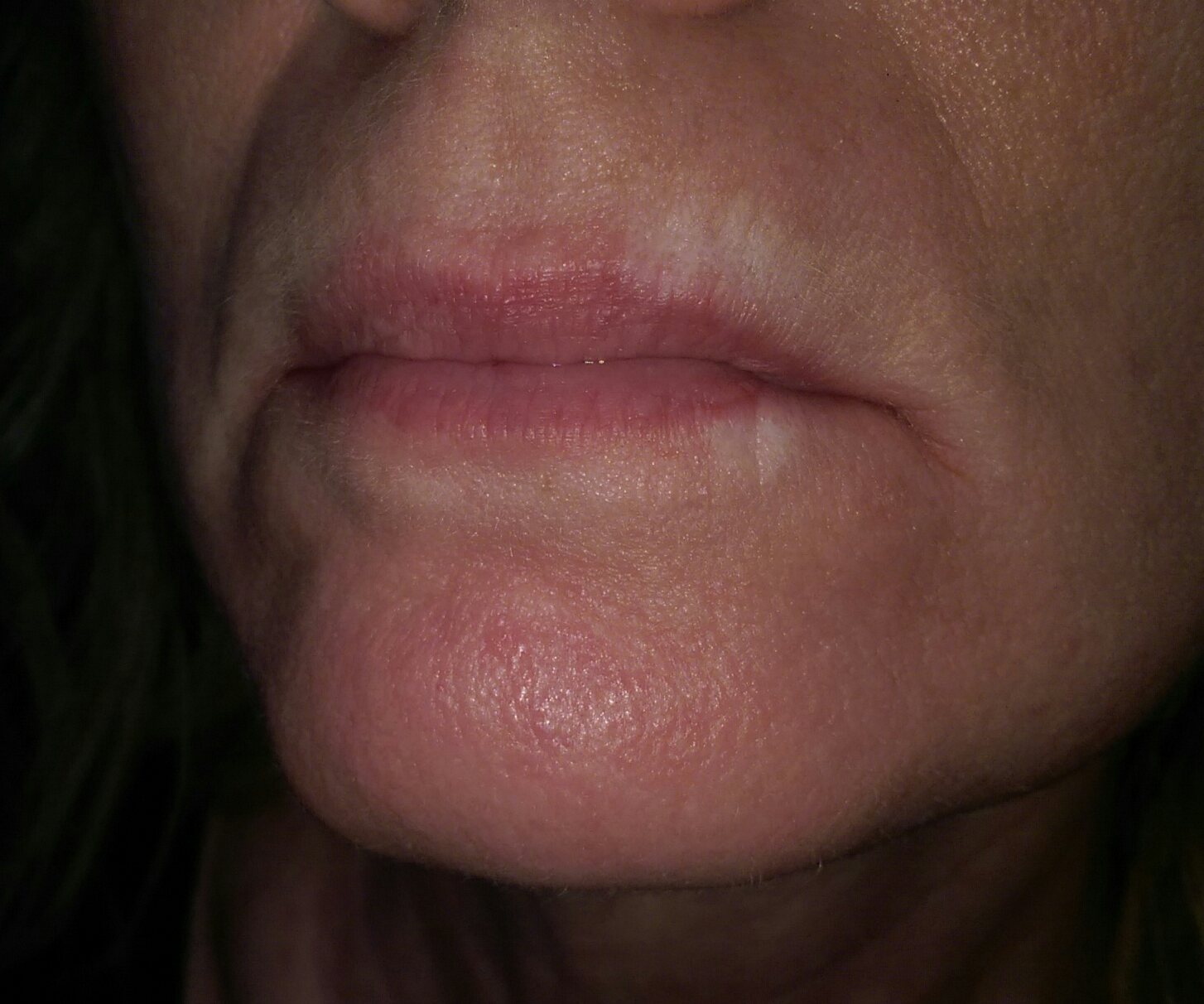 scar on lips