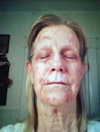 Carol after chemo cream